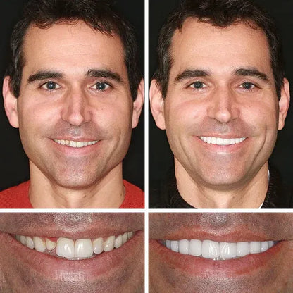🌎Ends Today: 70% OFF! ⏰meleval® Medical Full Denture with Strong Suctiond🦷Obtain American Dental Association (ADA) Certification