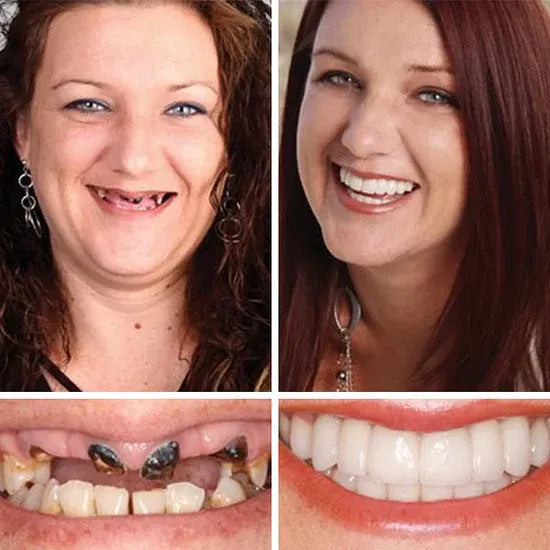 🌎Ends Today: 70% OFF! ⏰meleval® Medical Full Denture with Strong Suctiond🦷Obtain American Dental Association (ADA) Certification